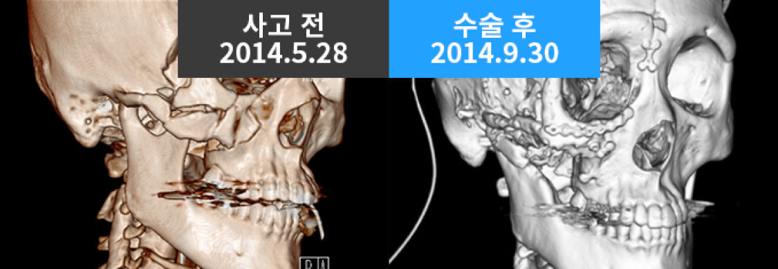 X-ray BEFORE / AFTER
