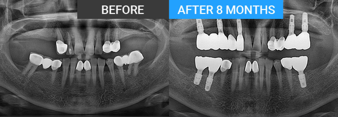 X-ray BEFORE / AFTER