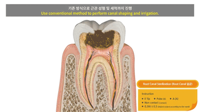 Root Canal Sterilization