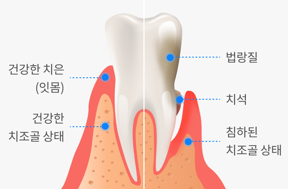 건강한 치은(잇몸)과 건강한 치조골 상태vs법랑질, 치석, 침하된 치조골 상태